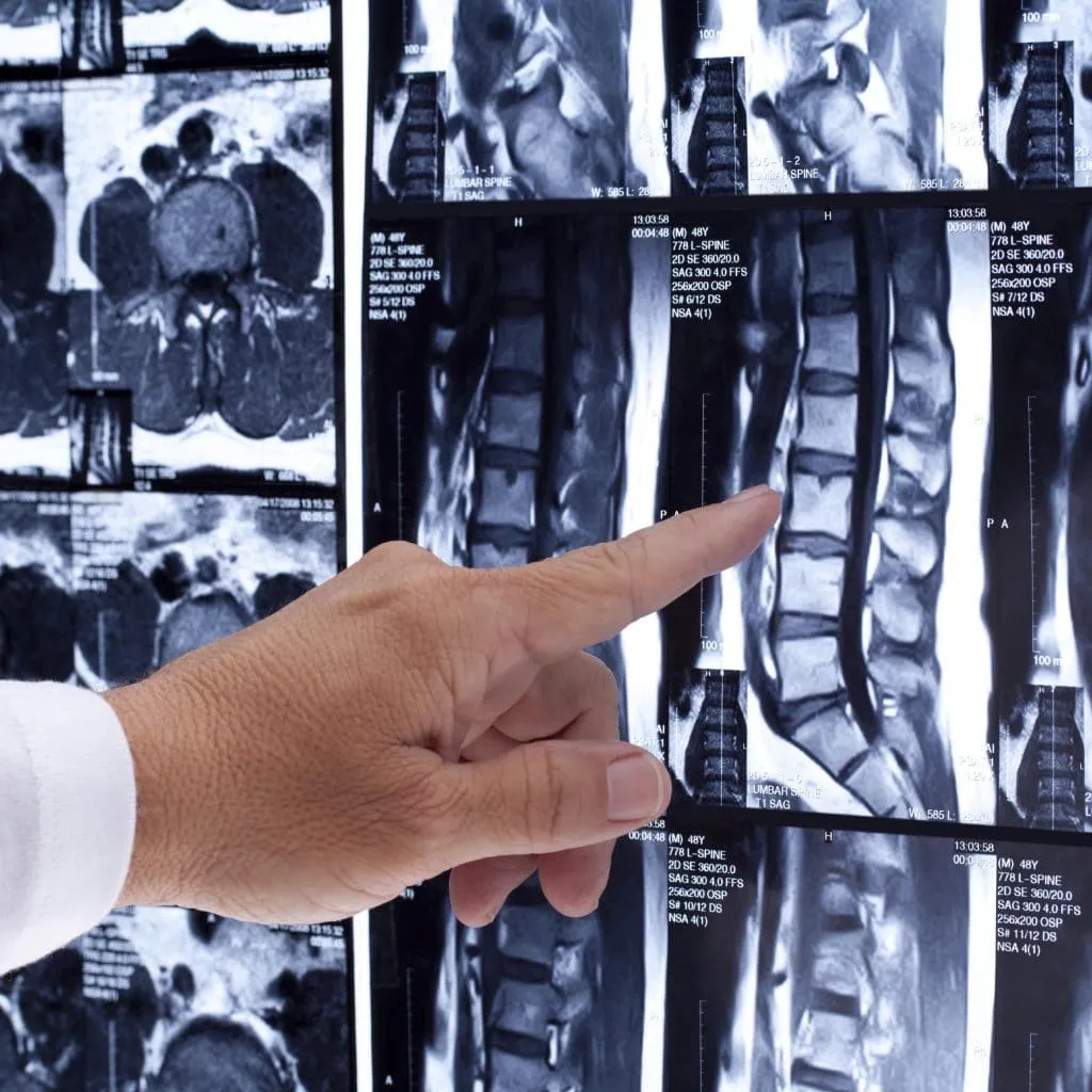 X-ray showing spinal injury. Joseph A. Nagy, injury lawyer in Edmonton, handles spinal cord claims for clients in Edmonton and throughout central and northern Alberta