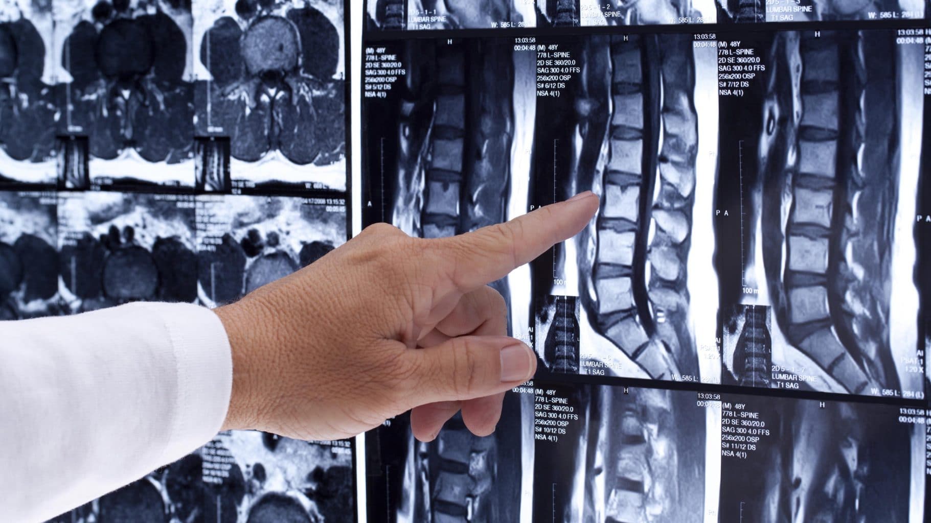 The pain from a spinal injury can be mistaken for the pain from a soft tissue injury. Edmonton injury lawyer, an experienced spinal injury lawyer, Joseph A. Nagy can refer his clients for orthopedic assessment.