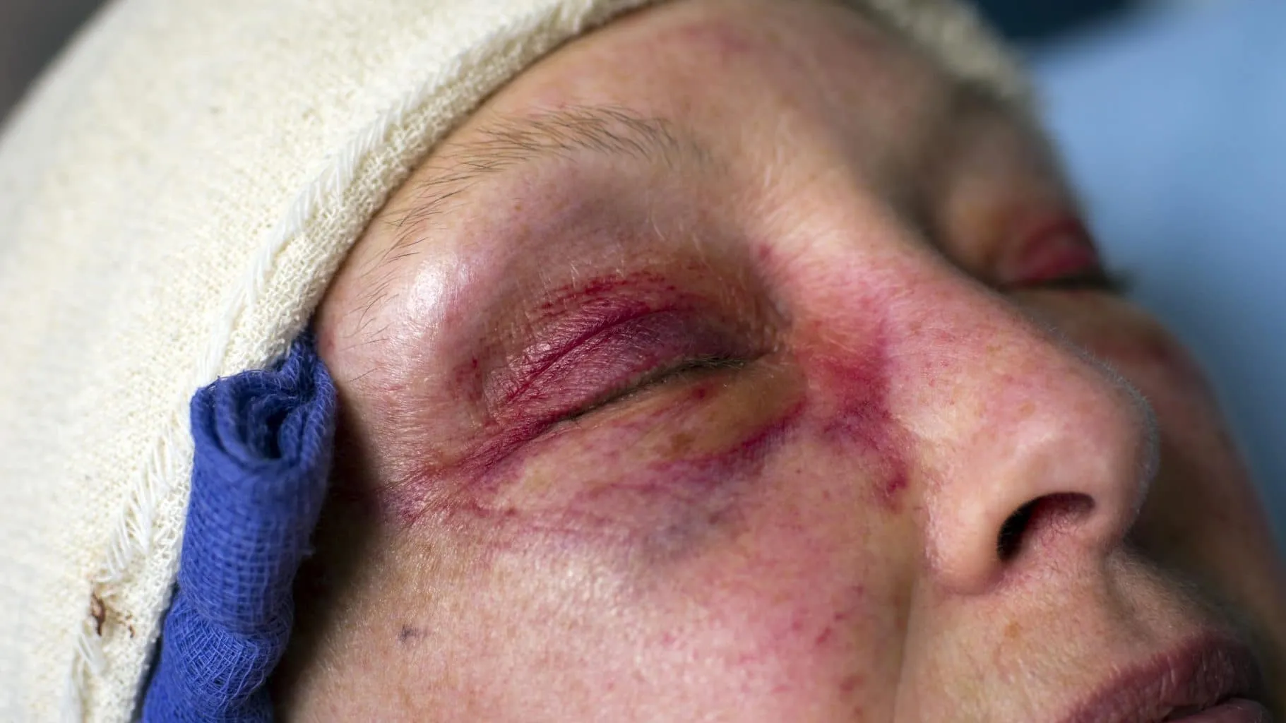 Photo of a woman suffering from a head injury. Joseph A. Nagy, an experienced Edmonton traumatic brain injury lawyer, can help prove insurable damages from a traumatic brain injury by making available the expertise of scientific, medical, and other personal injury experts.